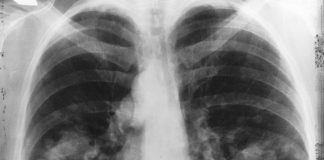 Um dos casos suspeitos de coronavírus de Varre-Sai testa negativo